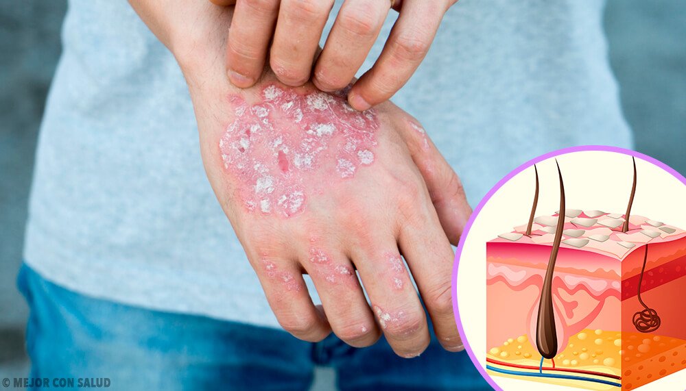 Psoriasis Ursachen Symptome Diagnose Und Behandlung Hogmag